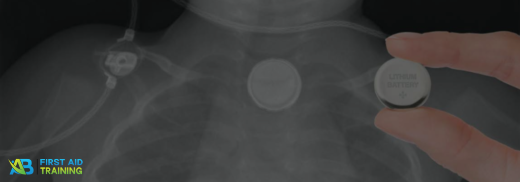 Button Battery Ingestion: First Aid Guidelines Every Childcare Educator Needs to Know