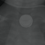 Button Battery Ingestion: First Aid Guidelines Every Childcare Educator Needs to Know